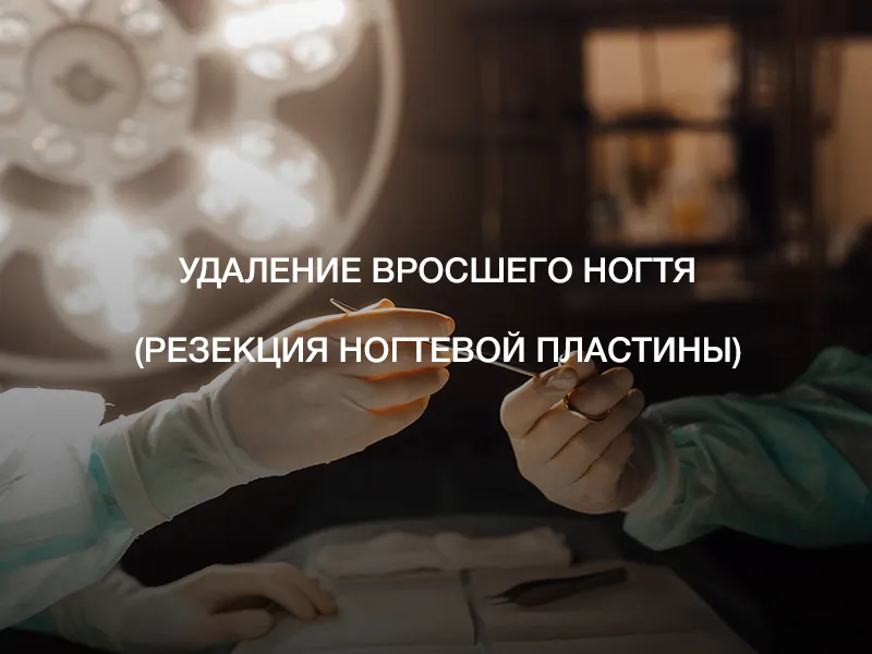 Удаление вросшего ногтя (резекция ногтевой пластины)