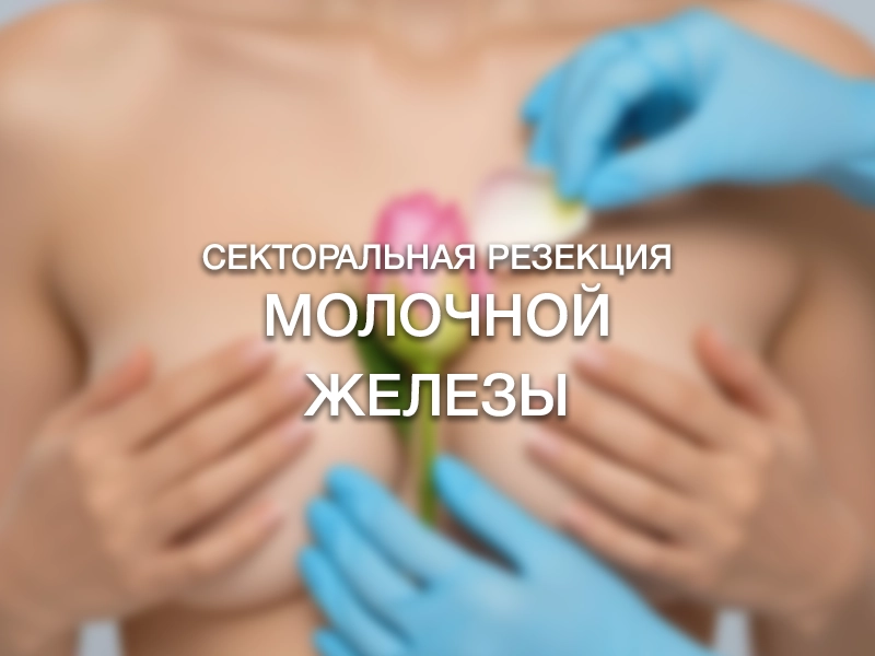 Секторальная резекция молочной железы