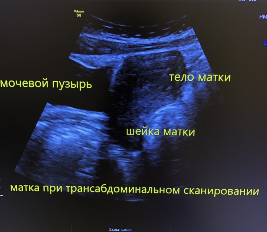матка при трансабдоминальном сканировании