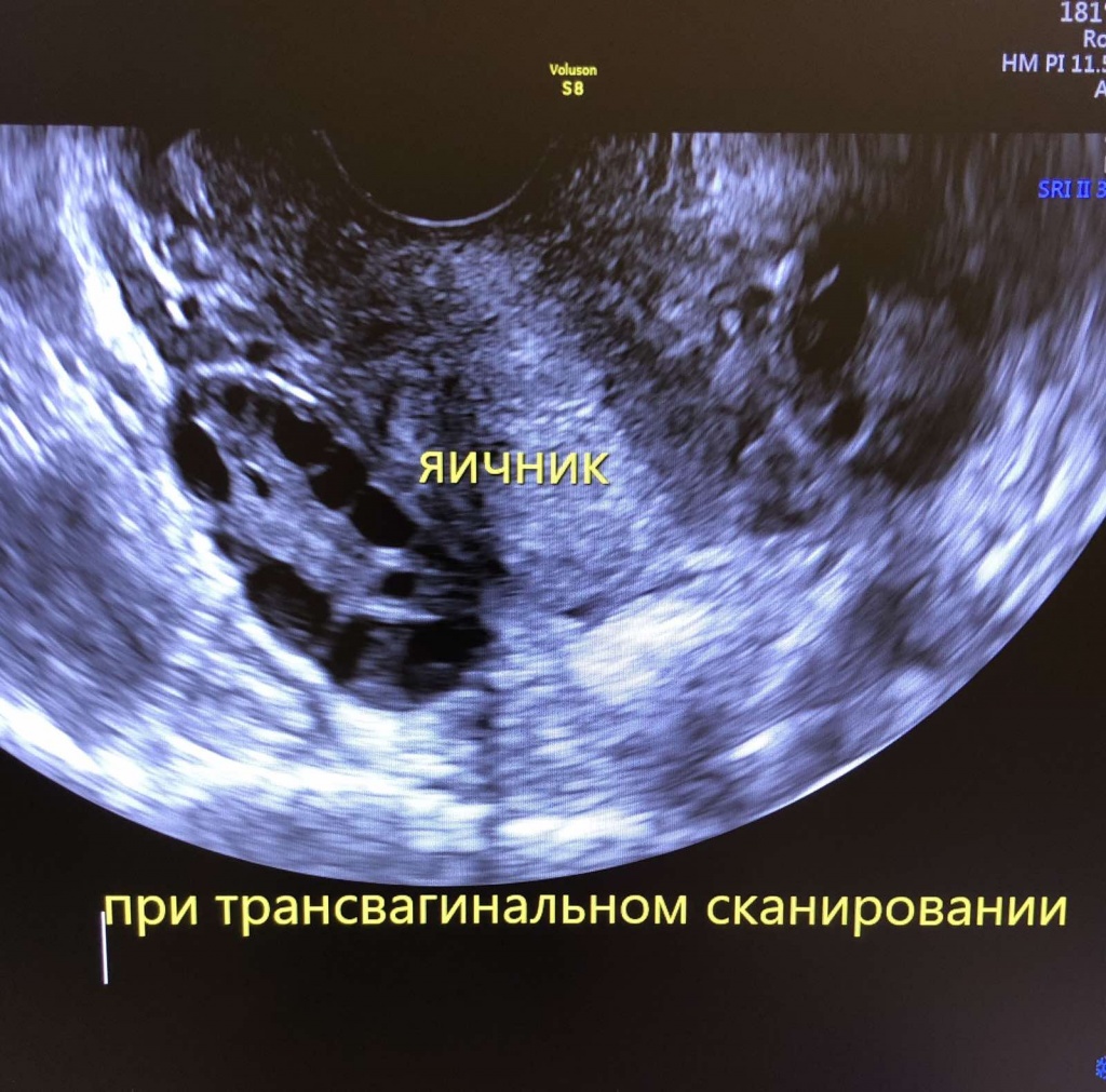 яичник при трансвагинальном сканировании